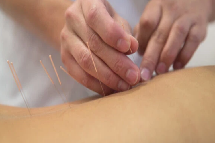 Điện mãng trâm điều trị bệnh trĩ